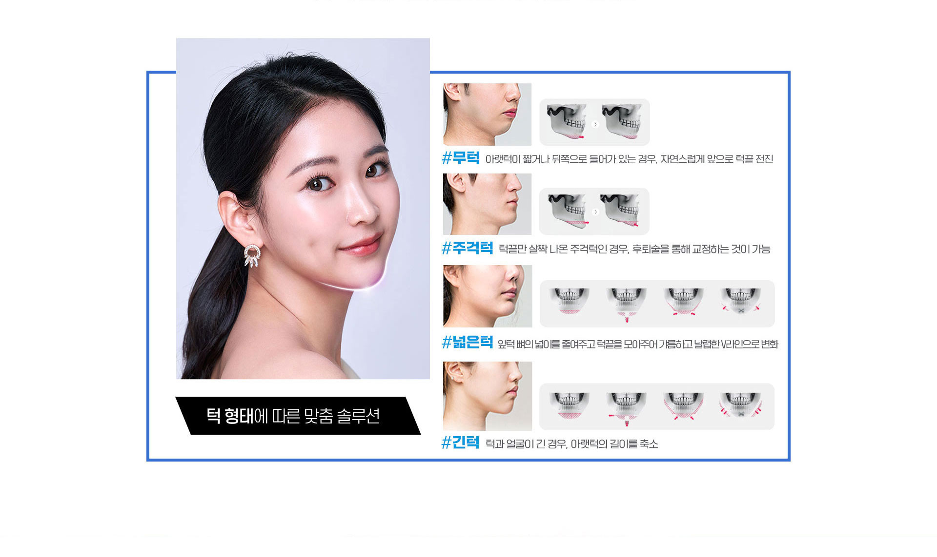 턱 형태에 따른 맞춤 솔루션,무턱,주걱턱,넓은턱,긴턱