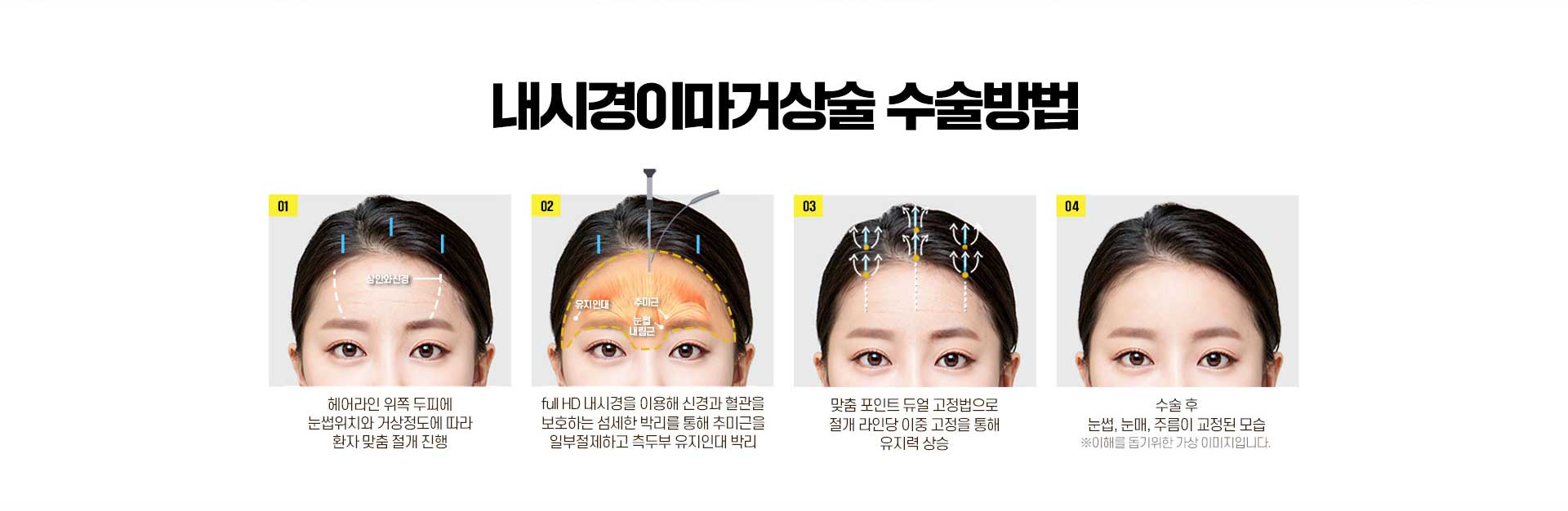 내시경이마거상술 수술방법