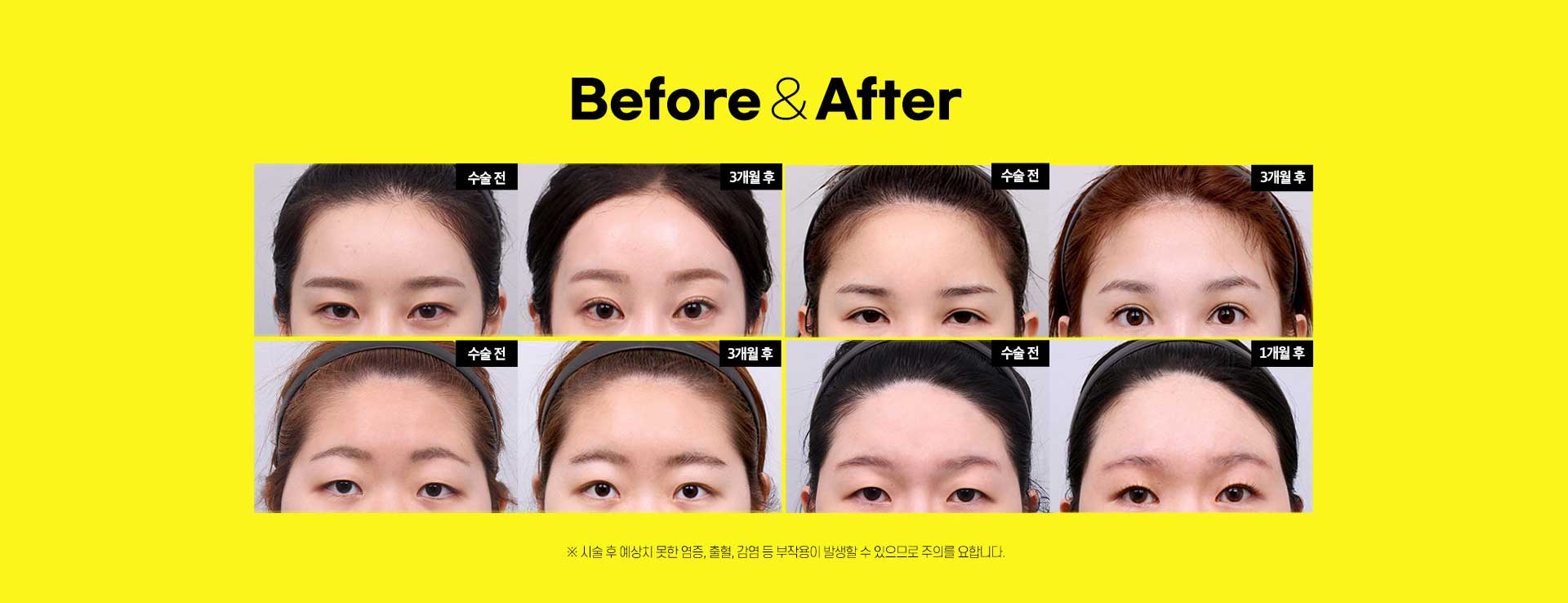 이마거상술 전후