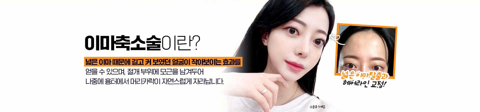 이마축소술