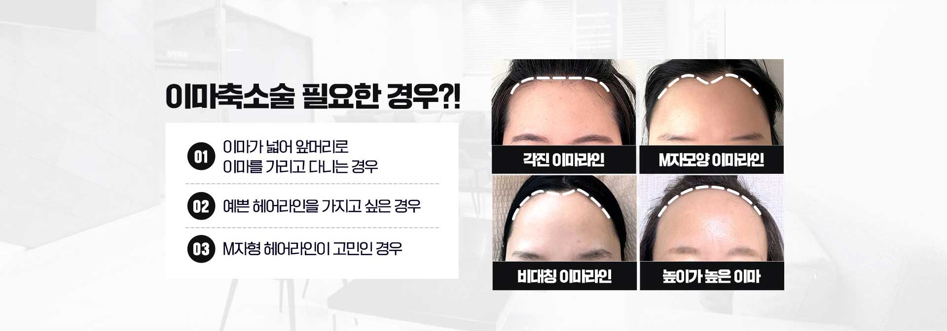 이마축소술 필요한경우