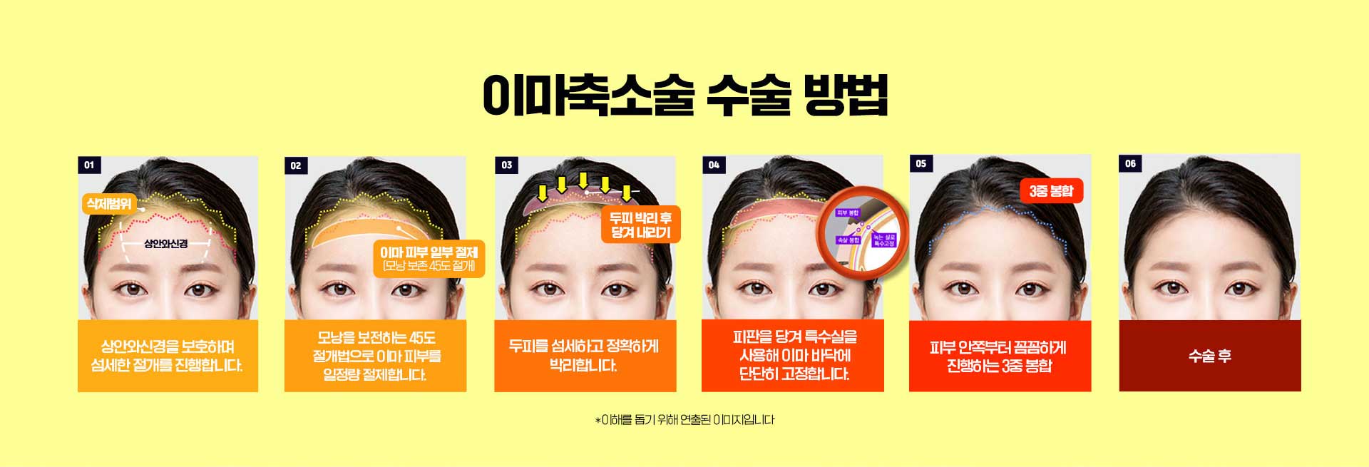 이마축소술 수술방법