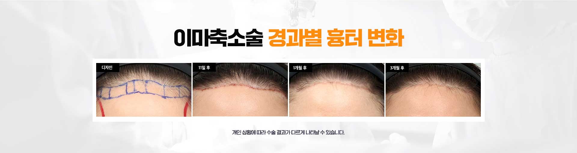 이마축소술 흉터변화